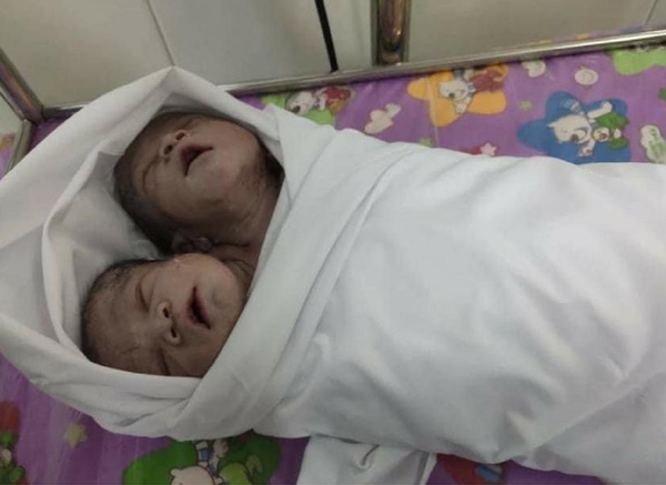 缅甸诞生双头连体婴儿（图片） - 俄罗斯卫星通讯社