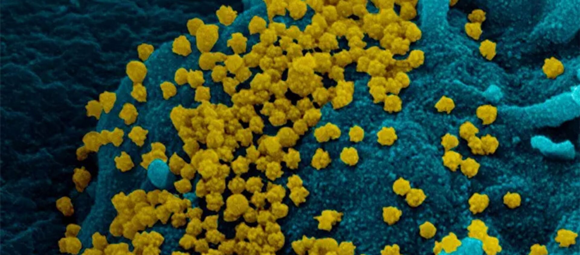Изображение SARS-CoV-2, полученное с помощью сканирующей электронной микроскопии мазка из носоглотки пациентки с ослабленным иммунитетом - 俄羅斯衛星通訊社, 1920, 30.12.2020