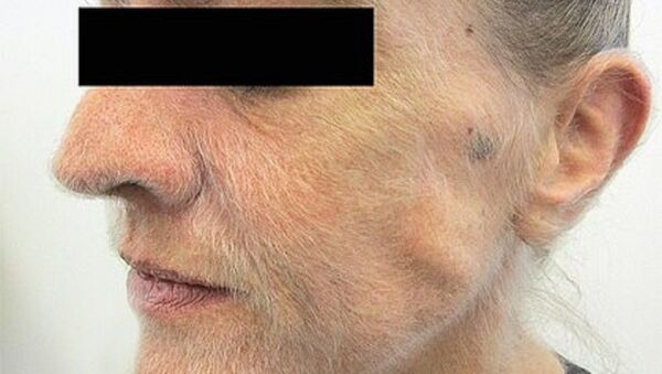 一名女子因肺癌脸上长出毛发 - 俄罗斯卫星通讯社