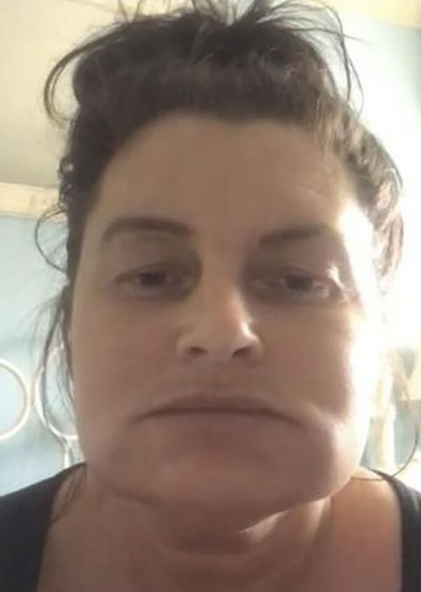 女子整容后成“大象人” 女子整容后成“大象人” - 俄罗斯卫星通讯社