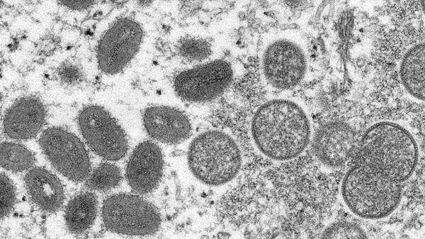 俄机构：圣彼得堡发现全国第二个猴痘感染病例 - 俄罗斯卫星通讯社