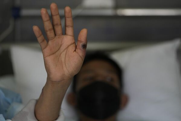 2022年8月16日，在秘魯利馬的一家醫院，一名患者展示了因猴痘引起酸痛的雙手。 - 俄羅斯衛星通訊社