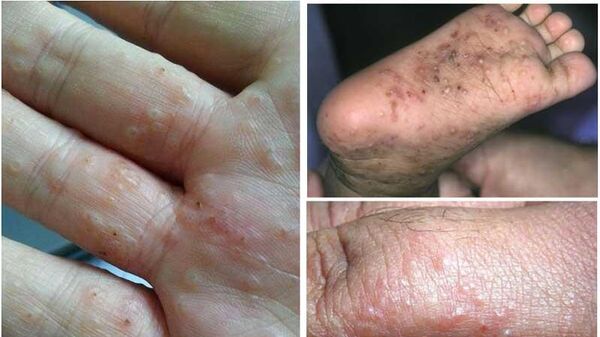 疥疮 - 俄罗斯卫星通讯社