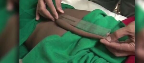 一名印度年轻人切除长达18厘米的尾巴 - 俄罗斯卫星通讯社