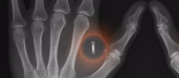 瑞典公司职员在身体里植入电子芯片 - 俄罗斯卫星通讯社