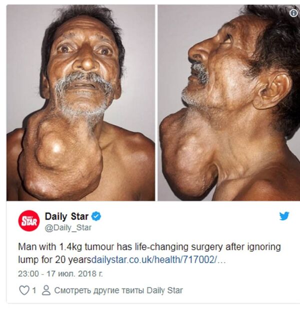 印度男子患肿瘤20年 长到头部大小才就医 - 俄罗斯卫星通讯社