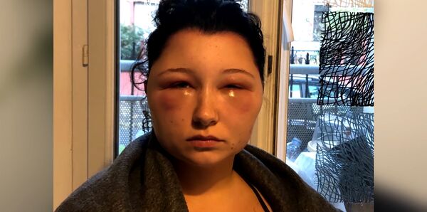 法国女大学生染发剂过敏致脸部肿胀变形 - 俄罗斯卫星通讯社