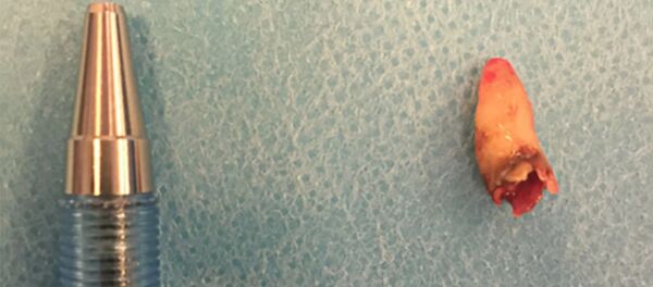 丹麦男子鼻内长出牙齿 丹麦男子鼻内长出牙齿 - 俄罗斯卫星通讯社