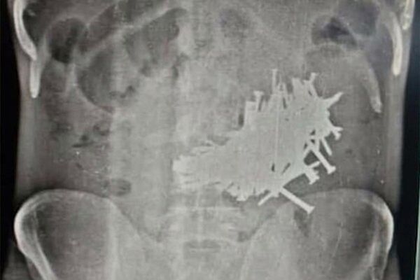 印度男子吞116根釘子後幸存 - 俄羅斯衛星通訊社