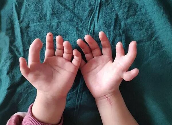 一女士穿緊身內衣16年 換來胸口一個洞 - 俄羅斯衛星通訊社