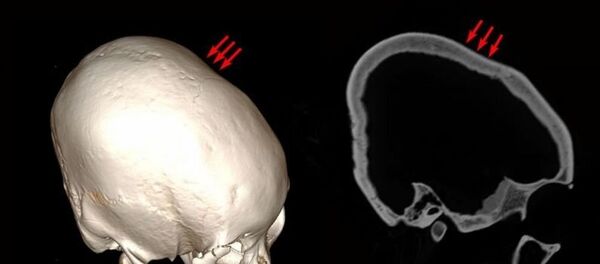 在中国发现了有12000年历史的变形头骨 - 俄罗斯卫星通讯社