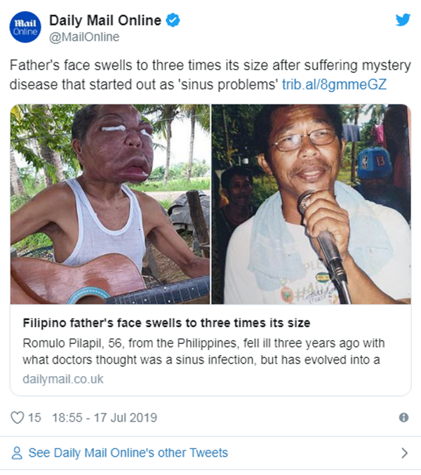 男子得怪病臉腫大三倍 - 俄羅斯衛星通訊社