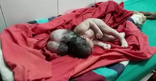 印度的“三頭”嬰兒難住了大夫 印度的“三頭”嬰兒難住了大夫 - 俄羅斯衛星通訊社