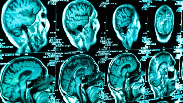КТ сканирование мозга человека - 俄羅斯衛星通訊社