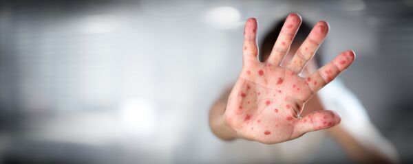 Ребенок, заболевший корью - 俄羅斯衛星通訊社