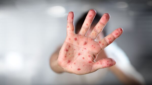 麻疹病例 - 俄罗斯卫星通讯社