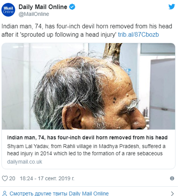 印度男子头上10厘米“恶魔角”被切除 - 俄罗斯卫星通讯社