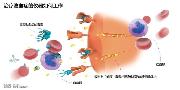 治疗败血症的仪器如何工作 治疗败血症的仪器如何工作 - 俄罗斯卫星通讯社