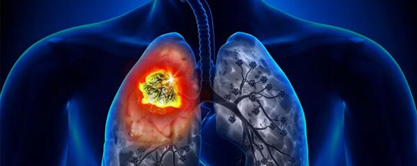 Рак легких - 俄罗斯卫星通讯社