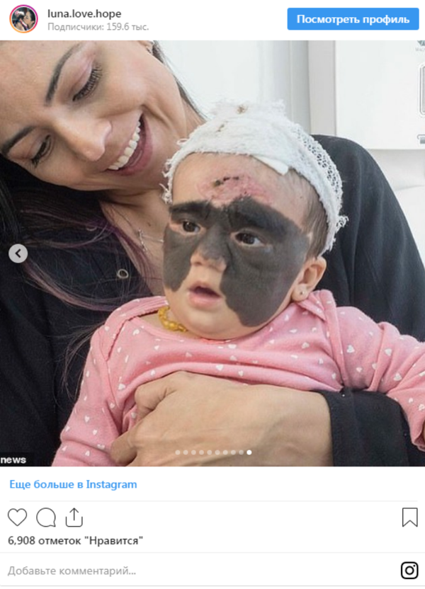 满脸胎记新生儿的母亲展示手术结果 （图片） - 俄罗斯卫星通讯社