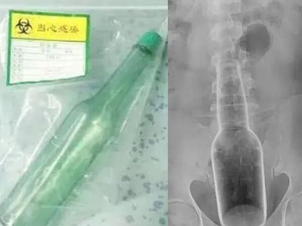 華媒：東莞一男子將18釐米長的花露水瓶塞進體內 （圖片） - 俄羅斯衛星通訊社