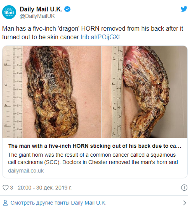 一名英国人背上长出14厘米的角 (图片) 一名英国人背上长出14厘米的角 (图片) - 俄罗斯卫星通讯社