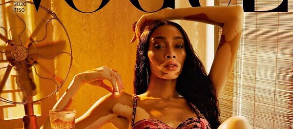 Модель с заболеванием кожи снялась для обложки журнала Vogue в бюстгальтере - 俄羅斯衛星通訊社