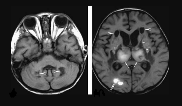 医生越来越多发现感染CoViD-19病毒的患者有严重脑损伤 - 俄罗斯卫星通讯社
