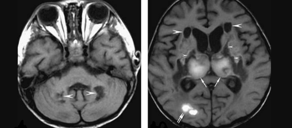 医生越来越多发现感染CoViD-19病毒的患者有严重脑损伤 医生越来越多发现感染CoViD-19病毒的患者有严重脑损伤 - 俄罗斯卫星通讯社