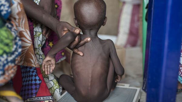 Истощенный от голода ребенок, Нигерия - 俄羅斯衛星通訊社