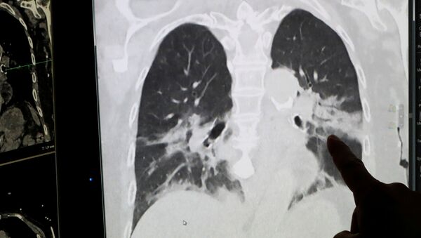 華媒：一名新冠肺炎終末期患者成功接受肺移植  　　 - 俄羅斯衛星通訊社