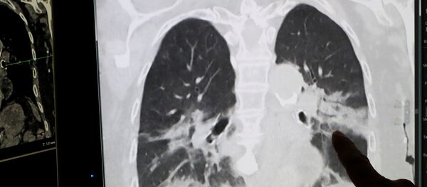 华媒：一名新冠肺炎终末期患者成功接受肺移植  　　 - 俄罗斯卫星通讯社